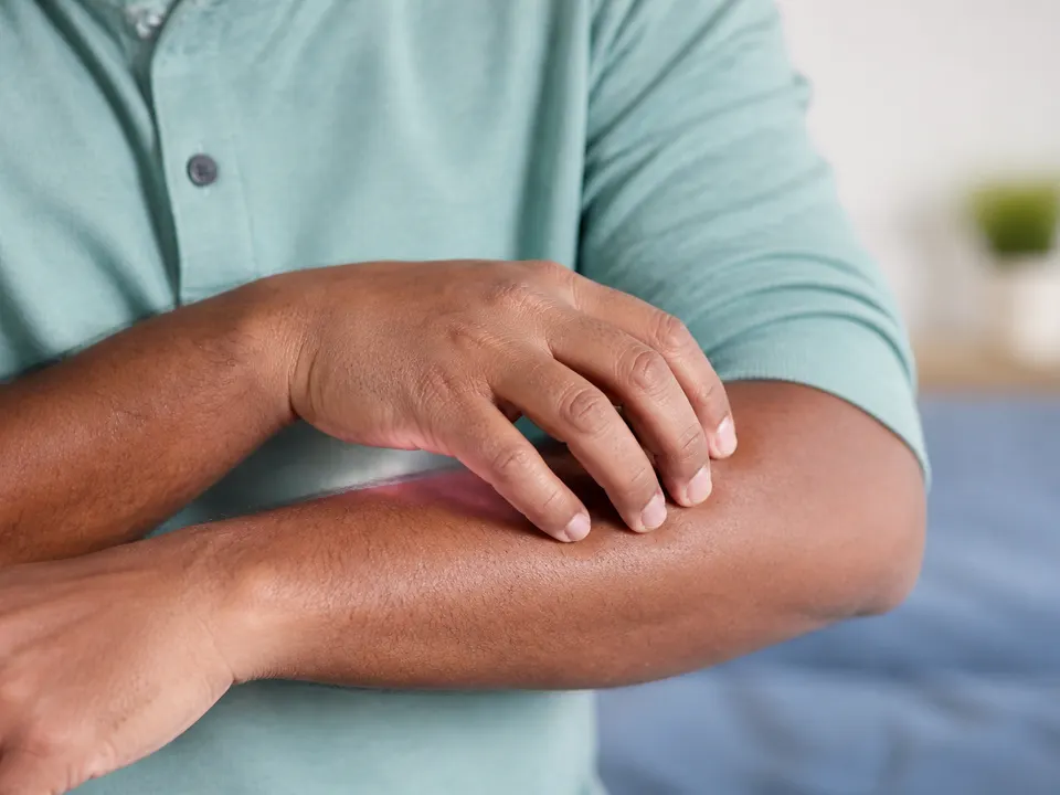 Itch or Skin Change — educational photograph
